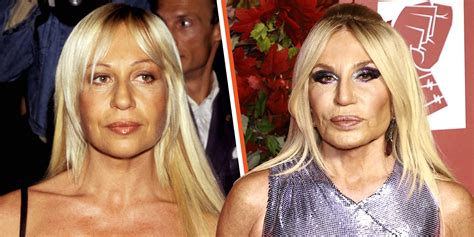 Experts Believe Donatella Versace Had Several 